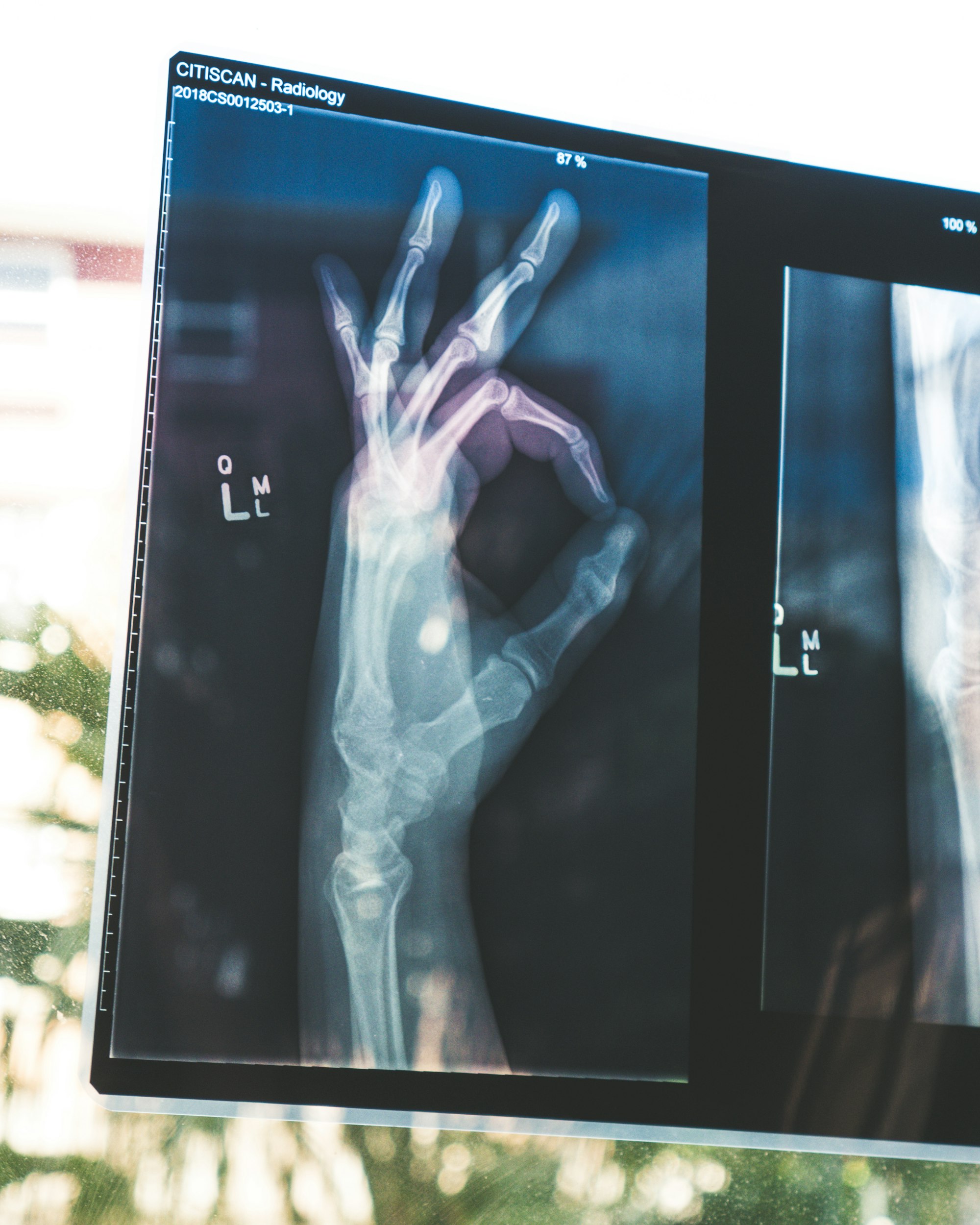 Digital X-ray on a radiology monitor, representing Clinova’s X-ray and imaging services.
